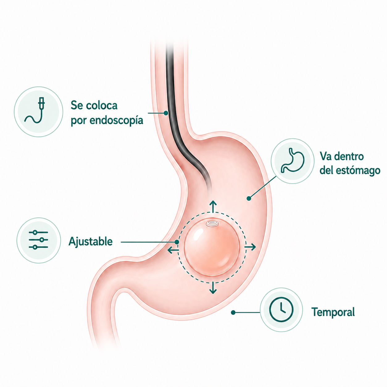 Ilustración del balón gástrico Spatz dentro del estómago, con las etiquetas se coloca por endoscopía, va dentro del estómago, ajustable y temporal